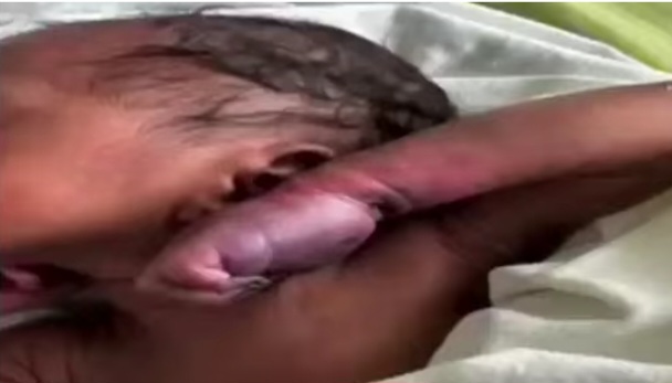 Premature baby's hand amputated after alleged neglect at Hohoe Hospital